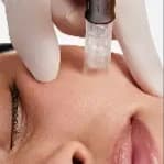 Microneedling Renewal Package at Nourish & Nurture Esthetics in Charlotte, NC